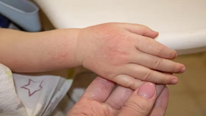 أسباب حساسية الجلد المفاجئة عند الأطفال أسباب حساسية الجلد المفاجئة عند الأطفال
