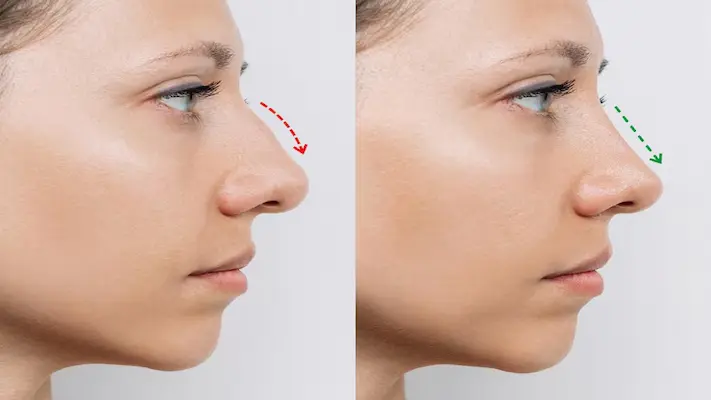 كل ما تحتاج معرفته عن عملية تجميل الانف كل ما تحتاج معرفته عن عملية تجميل الانف