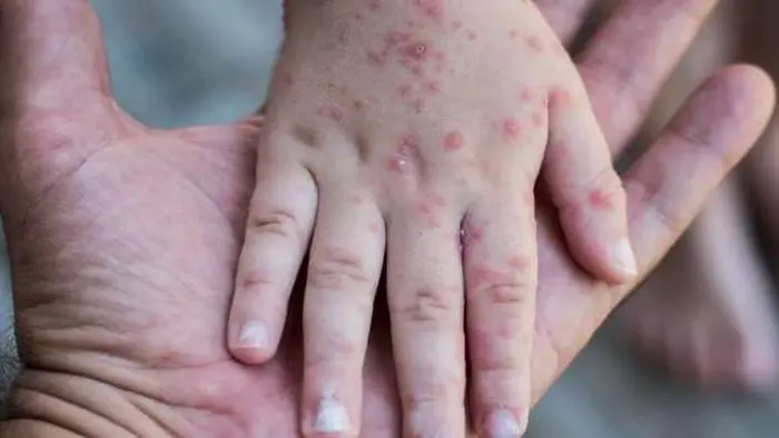تعرف على طرق علاج الجديري المائي ونصائح للوقاية من العدوى تعرف على طرق علاج الجديري المائي ونصائح للوقاية من العدوى
