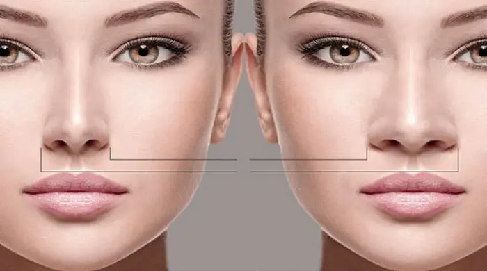 تجميل الانف اللحمي العريض لإطلالة رائعة وجذابة تجميل الانف اللحمي العريض لإطلالة رائعة وجذابة