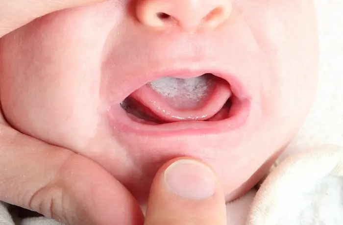 فطريات الفم للأطفال الأسباب الأعراض وطرق العلاج فطريات الفم للأطفال الأسباب الأعراض وطرق العلاج
