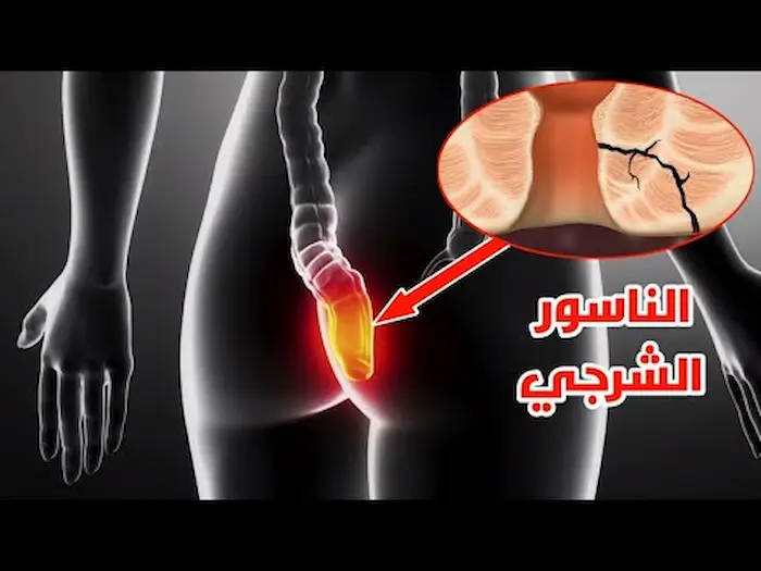 مرض الناسور الأسباب الأعراض والعلاج مرض الناسور الأسباب الأعراض والعلاج