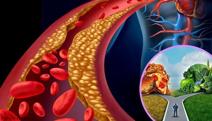 اعراض الدهون الثلاثية | العلامات والأسباب اعراض الدهون الثلاثية | العلامات والأسباب