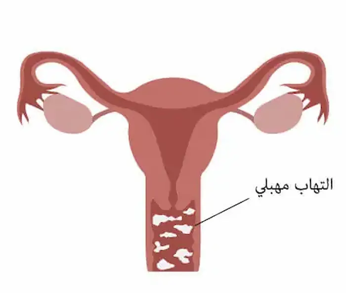 علاج التهاب المهبل الأنواع وطرق الوقاية علاج التهاب المهبل الأنواع وطرق الوقاية