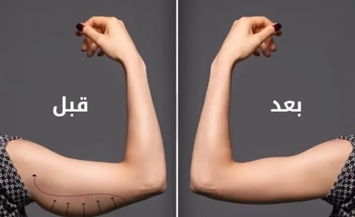 شد الذراعين بالفيزر نحت مثالي ونتائج فورية شد الذراعين بالفيزر نحت مثالي ونتائج فورية