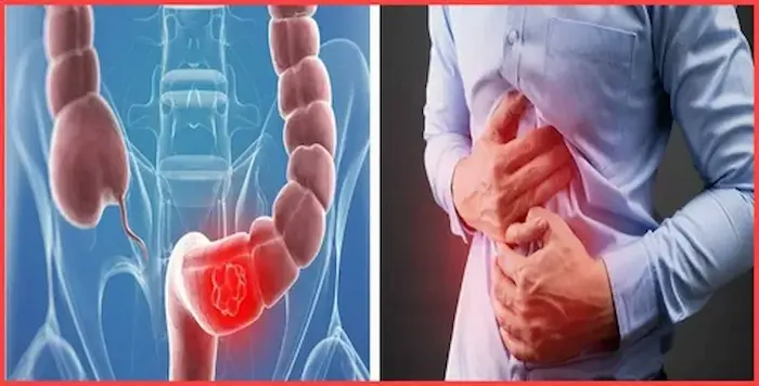 تعرف علي كيفية علاج غازات البطن تعرف علي كيفية علاج غازات البطن