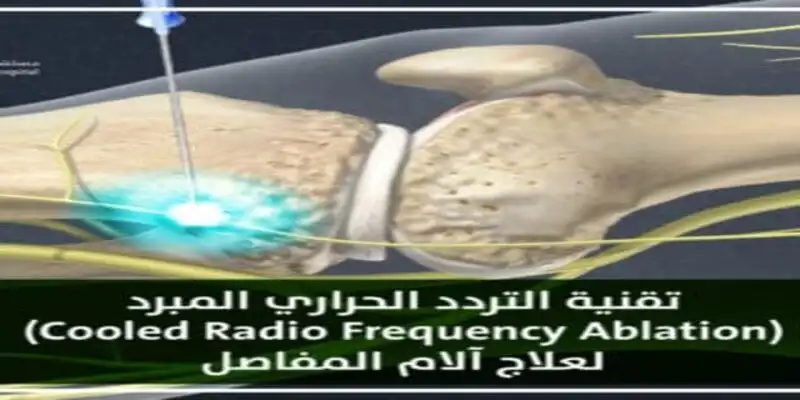 Cryogenic radiofrequency ablation for treatment joint pain