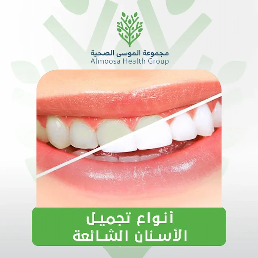 إليك كل ما تحتاج معرفته عن تجميل الأسنان وأهميته وأنواعه