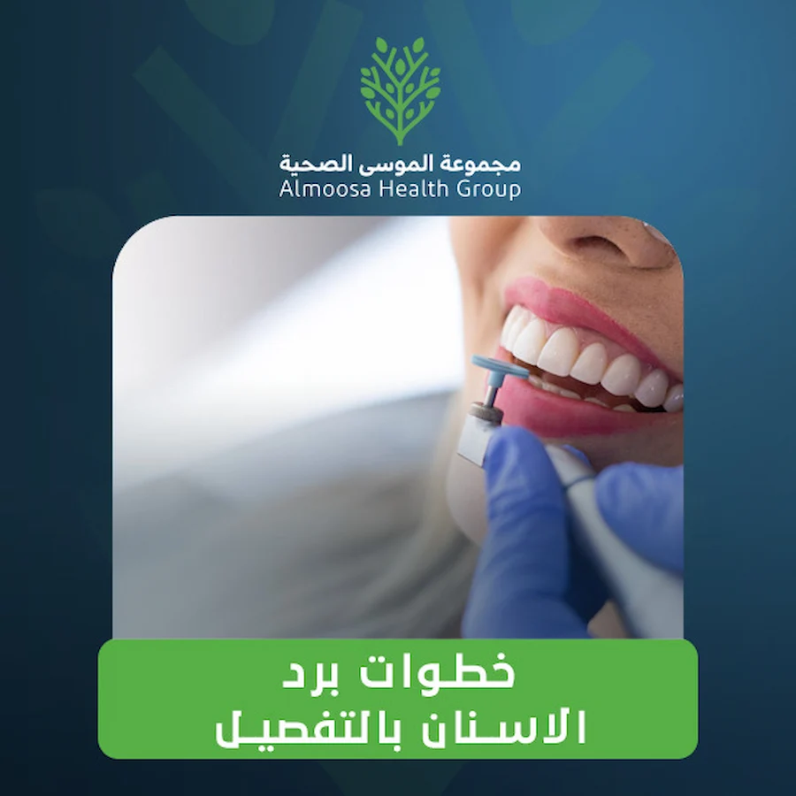 برد الاسنان: إجراء تجميلي دقيق لتحسين شكل الأسنان والابتسامة