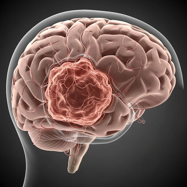 أنواع السرطان الدماغى