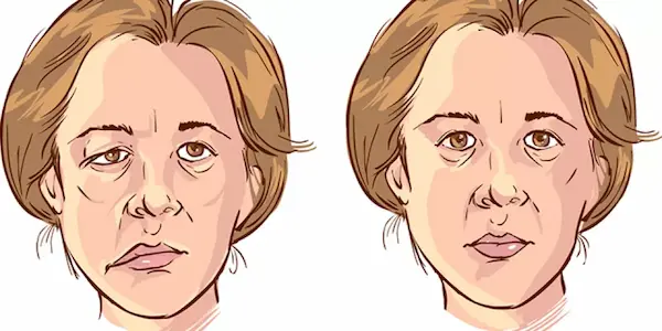 bells palsy b12 injections Botox For Bell's | Bell's Palsy Treatment Dallas Natural Bell's Palsy Treatment