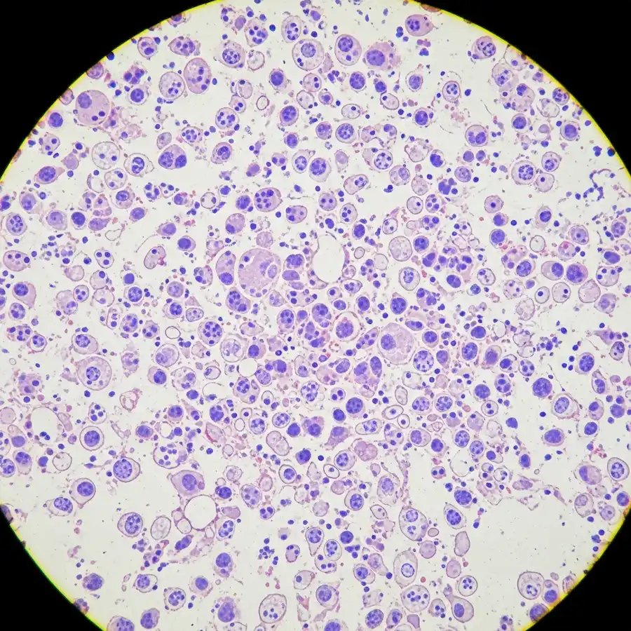 كل ما تريد معرفته عن ابيضاض الدم النقوي المزمن كل ما تريد معرفته عن ابيضاض الدم النقوي المزمن