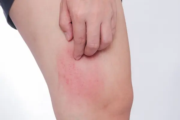 أعراض الحساسية