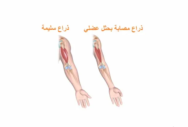 الحثل العضلي الدوشيني