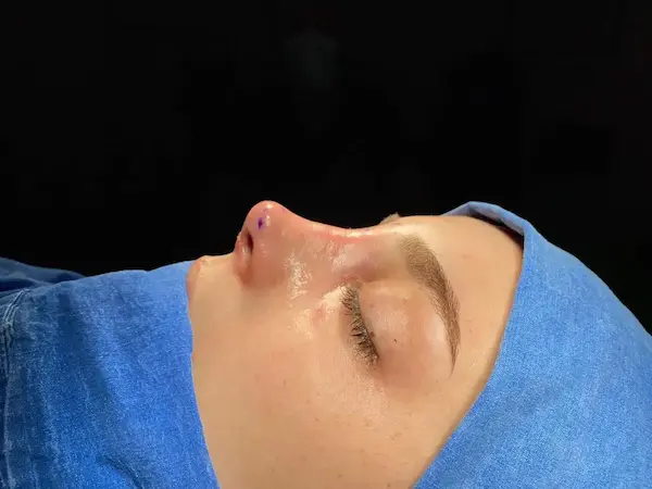 تجميل الانف اللحمي العريض