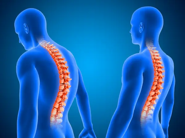 تشوهات العمود الفقري الخلقية