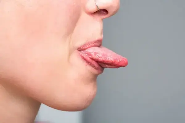 سرطان اللسان الحميد الأعراض الأسباب وطرق العلاج