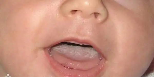 فطريات الفم للأطفال