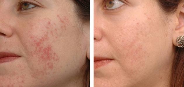 acne scars how long till glutathione heal it Permanent treatment of DR.VITA GLUTA IS FAKE? 1473 Size:90ct