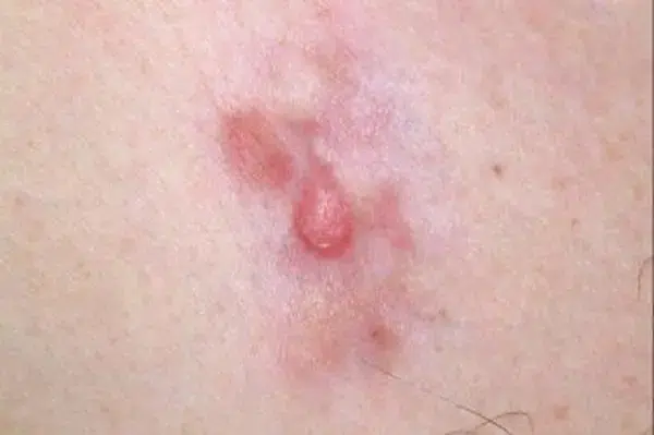 الساركوما الليفية الجلدية الحدبية الساركوما الليفية الجلدية الحدبية