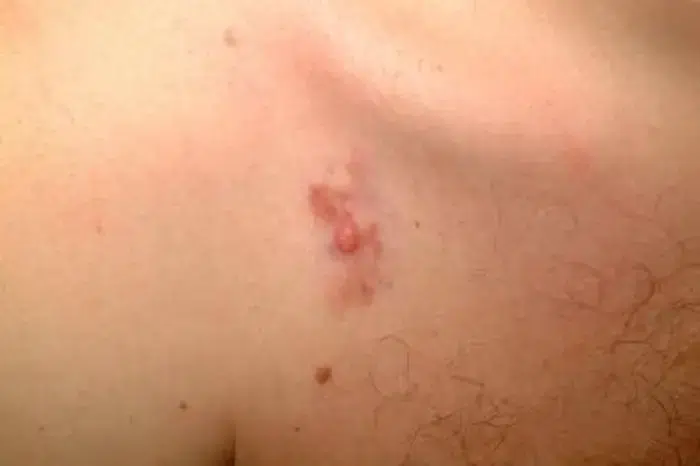 ما هي الساركوما الليفية الجلدية الحدبية؟ الأعراض وطرق التشخيص والعلاج ما هي الساركوما الليفية الجلدية الحدبية؟ الأعراض وطرق التشخيص والعلاج