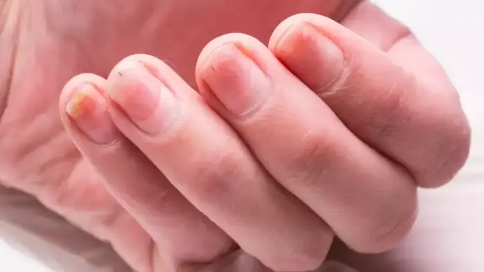 انفصال الظفر عن اللحم: مشكلة شائعة يمكن علاجها بسهولة