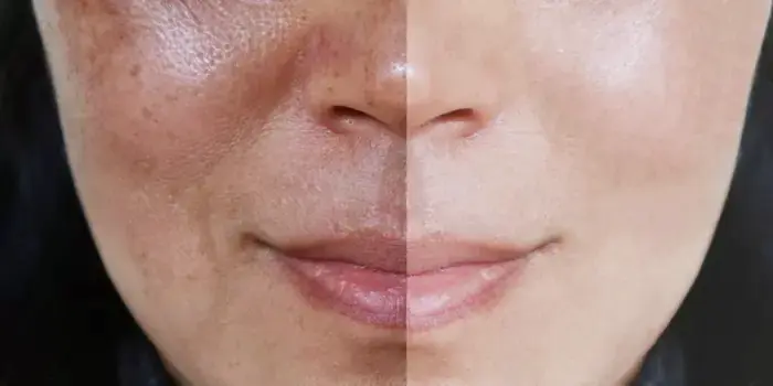 أفضل طرق علاج الكلف والتصبغات سريعًا بوسائل طبية طبيعية وآمنة أفضل طرق علاج الكلف والتصبغات سريعًا بوسائل طبية طبيعية وآمنة