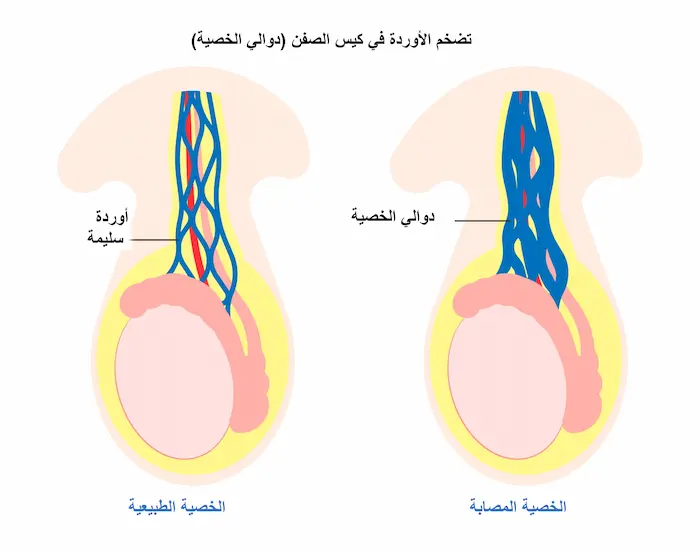 تعرف على أفضل علاج دوالي الخصية تعرف على أفضل علاج دوالي الخصية