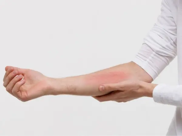 أفضل مستشفى لعمليات تجميل الحروق أفضل مستشفى لعمليات تجميل الحروق