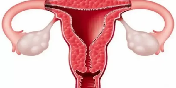 أنواع بطانة الرحم المهاجرة