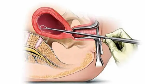 ادوية تنظيف الرحم بعد الاجهاض 