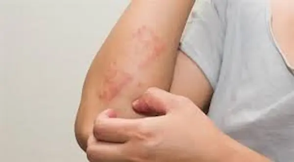 اعراض حساسية السمك اعراض حساسية السمك