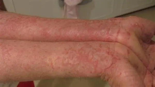 الإكزيما العصبية