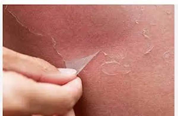 التقشير للمنطقه الحساسه