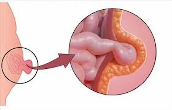 الفتاق السري