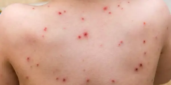 الفرق بين جدري القرود والجدري المائي