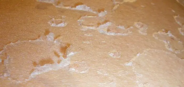 تقشير الجسم