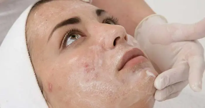 مع تقشير الفينول احصلي على نتائج مبهرة وجلد ناعم متجدد