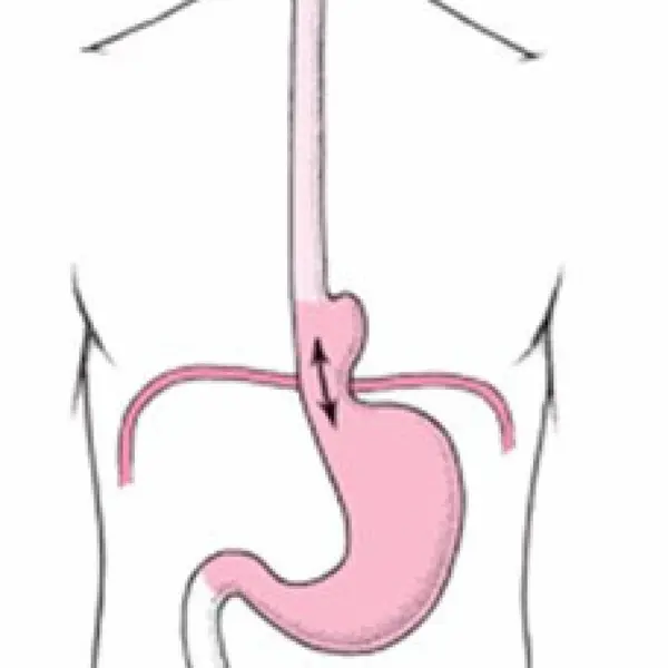 فتق الحجاب الحاجز
