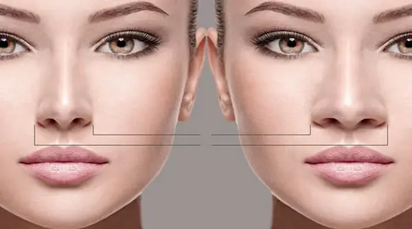 أرنبة الأنف العريضة أرنبة الأنف العريضة