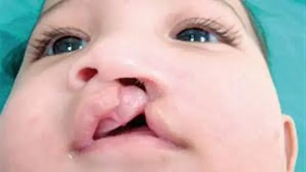 التشوهات الخلقية عند الاطفال حديثي الولادة