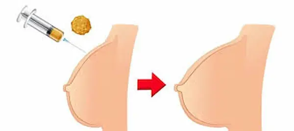 حقن دهون ذاتيه للصدر حقن دهون ذاتيه للصدر