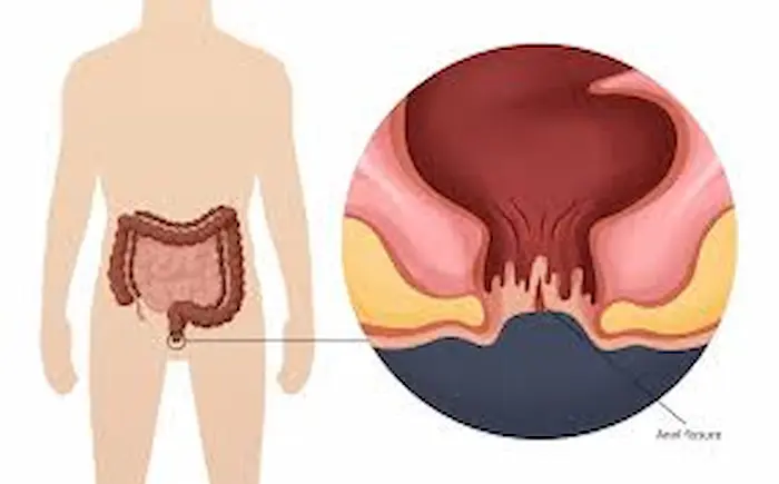 طرق علاج الشق الشرجي | الأسباب والأعراض وكيفية الوقاية طرق علاج الشق الشرجي | الأسباب والأعراض وكيفية الوقاية