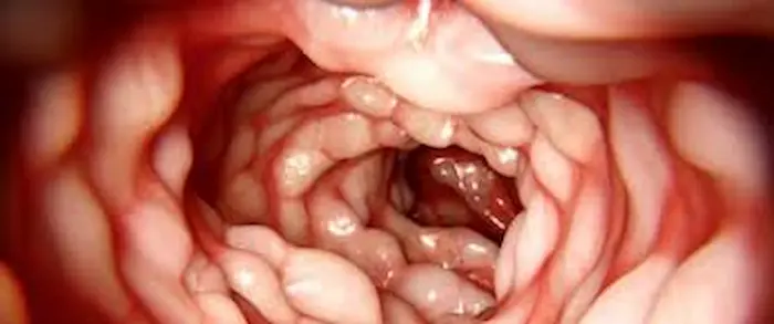 ماهو مرض كرون؟ الأسباب والأعراض ومتى يجب زيارة الطبيب؟