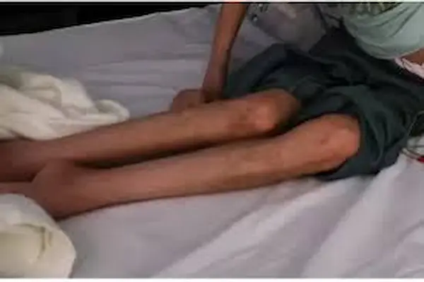 متلازمة غيلان باريه