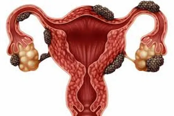 مرض أكياس الشوكولاتة