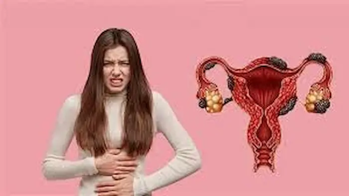 مرض أكياس الشوكولاتة: أسبابها وأعراضها وطرق العلاج والسيطرة عليها مرض أكياس الشوكولاتة: أسبابها وأعراضها وطرق العلاج والسيطرة عليها